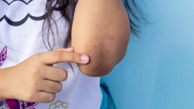 Acanthosis Nigricans – Symptoms, Causes & Treatment